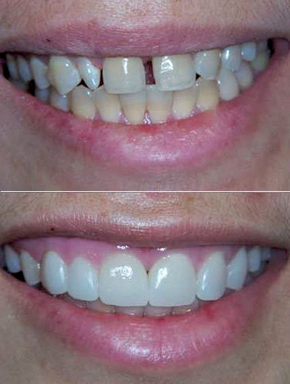 "عمليات تجميل الأسنان قبل وبعد"