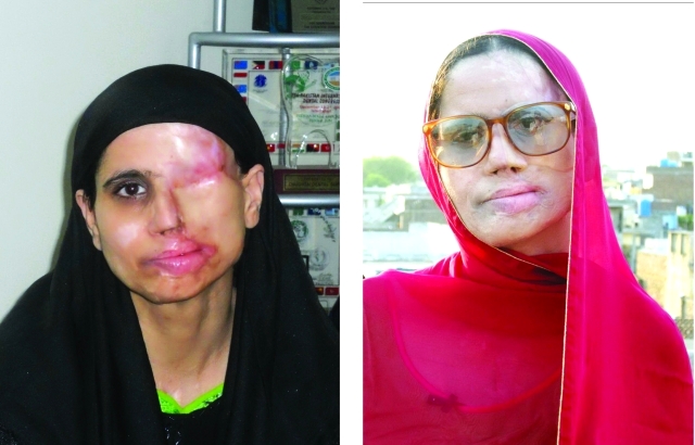 "إعادة البسمة إلى وجه امرأة باكستانية"