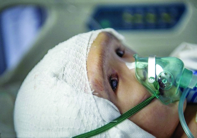 "الطفلة قبل العملية وبعدها"