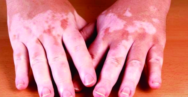 "■ للوراثة والعوامل الجينية دور في الإصابة بالمرض | من المصدر"