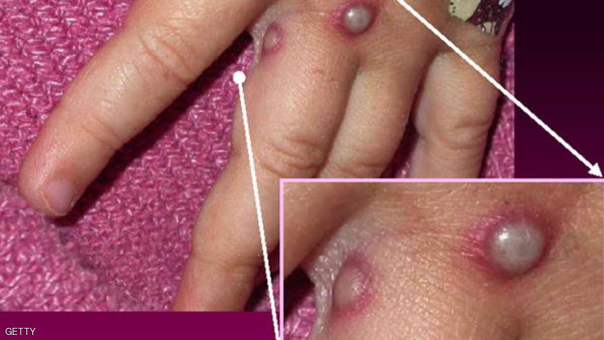 فيروس قاتل يهدد العالم وهلع كبير من انتشاره