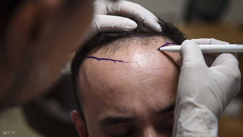 علاج الصلع بات ممكناً في 6 أيام فقط