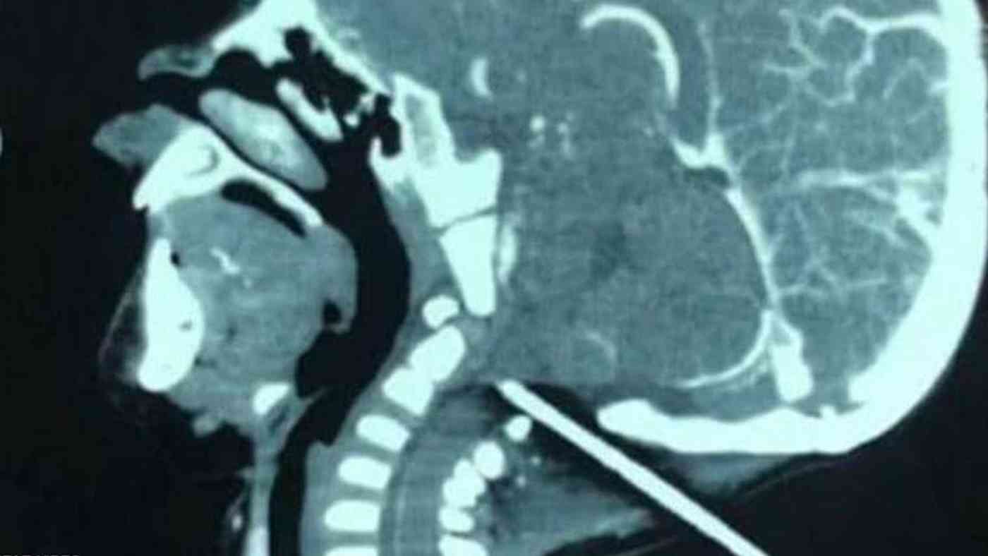 معجزة تنقذ طفلاً من الموت بعد إصابة مروعة