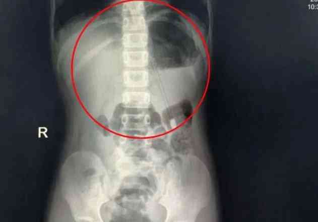 طفل يبلع قلم رصاص 18 سم.. بسبب الملل