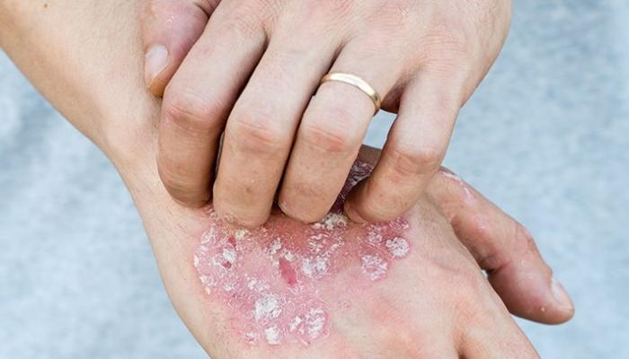 مرض الصدفية والبدائل الغذائية العلاجية
