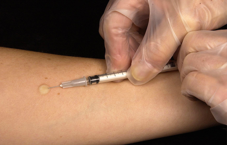 لقاح للسل يفوق جميع الأدوية المستخدمة في علاجه