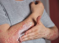 الصيام يعزز مناعة مرضى حساسية الطعام