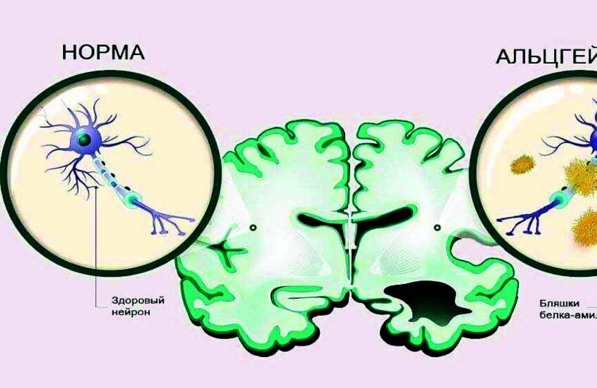 تراكم البروتينات يسبب الخرف