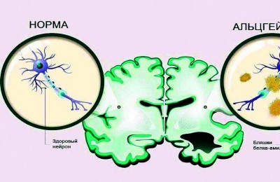 تراكم البروتينات يسبب الخرف