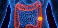 ما هو سرطان القولون والمستقيم وهل يمكن الوقاية منه؟