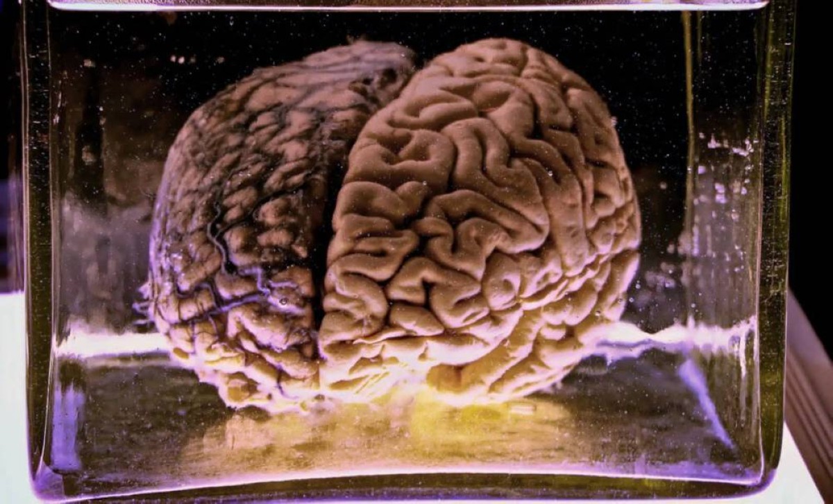 دماغ يتجمد عند 150 تحت الصفر ثم "يعود للحياة".. اختراق علمي يربك المفاهيم