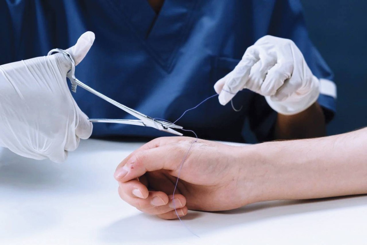 خيوط ذكية تعقّم الجرح