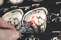 اكتشاف روسي جديد يفتح الطريق لتطوير أدوية لعلاج باركنسون