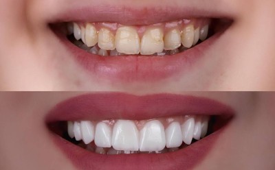 في 30 دقيقة فقط.. تقنية جديدة تُحدث ثورة في علاجات الأسنان