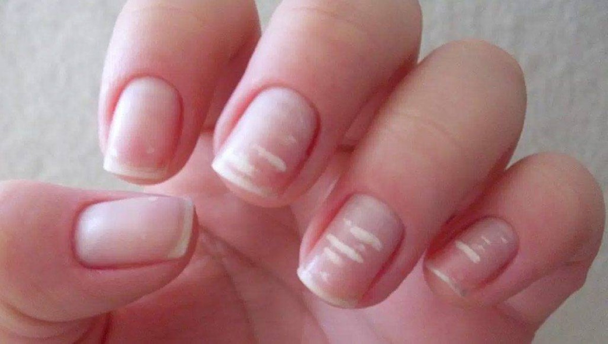 ماذا تخبرك أظافرك عن صحتك؟