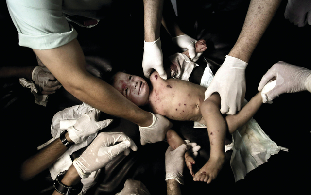 الصورة : طفلة من ضحايا العدوان الإسرائيلي تتلقى العلاج في مستشفى الشفاء بغزة       أ.ب