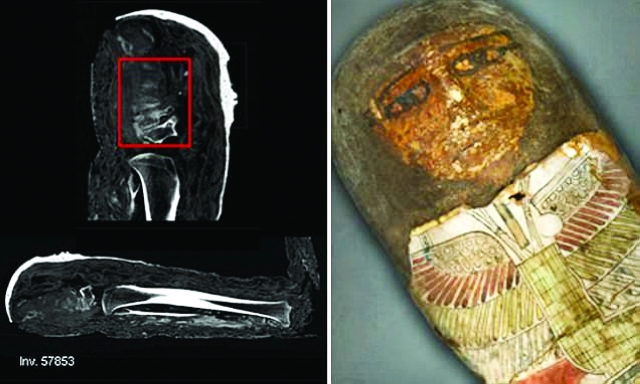 الصورة : العثور على «مسمار من العصر الحديث» في عظام إحدى المومياوات