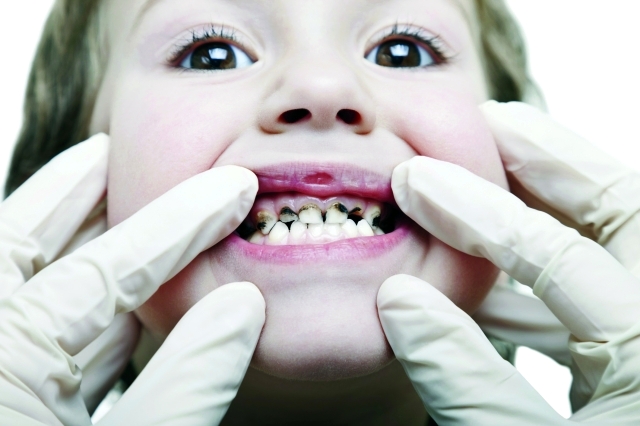 الصورة : أسنان الأطفال عرضة للتسوس بفعل أخطاء كثيرة