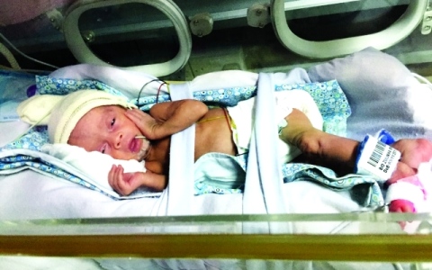 الصورة: الصورة: أطباء مستشفى لطيفة ينقذون حياة طفلة ولدت  في الأسبوع 22 لتعيش دون إعاقة