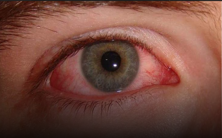 4 علامات تظهر على العين تؤكد الإصابة بكورونا Image
