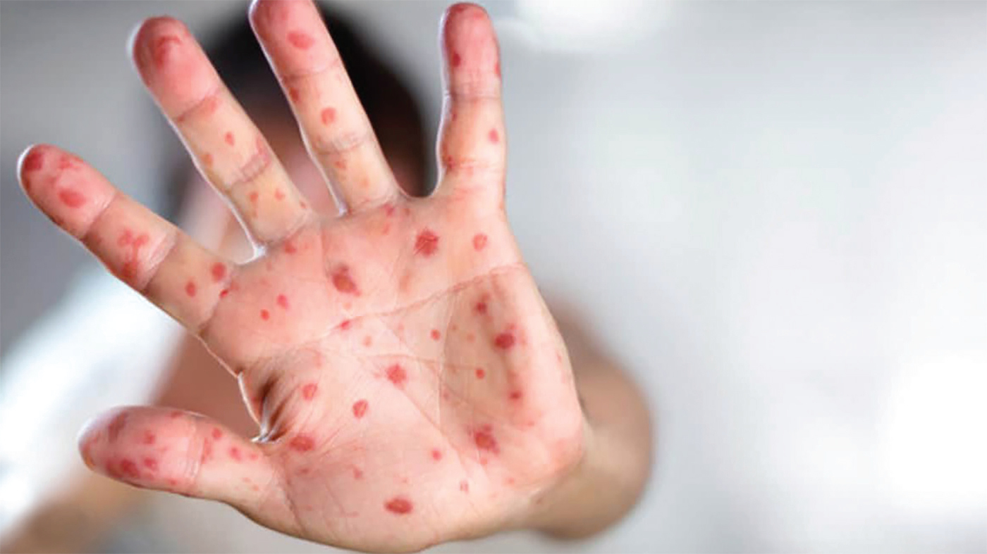 البقع الحمراء على راحة اليد قد تؤشر إلى مرض خطير