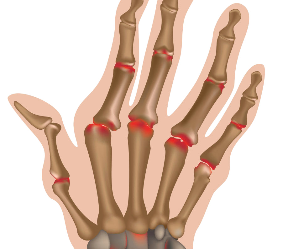 Артрит фаланговых суставов. Ревматоидный артрит суставы. Ревматоидный артрит кистей пальцев рук. Подагра ревматоидный артрит кистей. Ревматоидный артрит фото суставов.