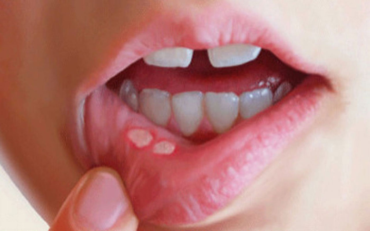صورة أعراض في الفم تحذر من نقص شديد في فيتامين ب 12 – البيان الصحي