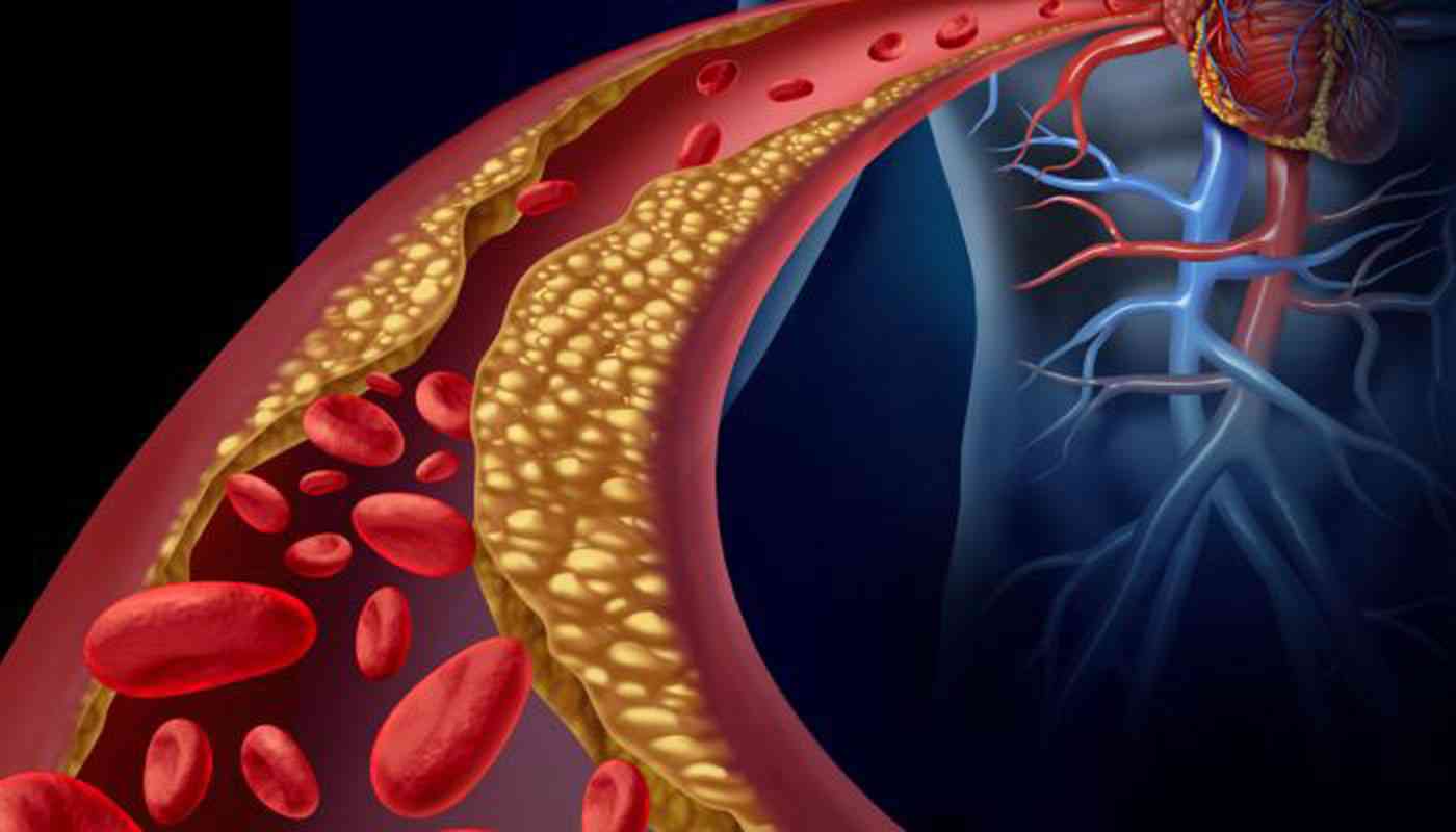 ارتفاع الكوليسترول في الدم| صحتك