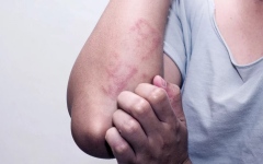 الصورة: الصورة: ولاية جوهور الماليزية تسجل نحو 7 آلاف إصابة بمرض جلدي