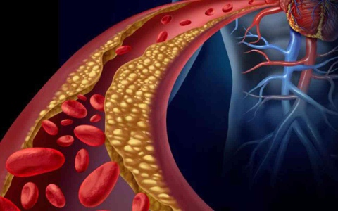 الصورة: الصورة: ارتفاع الكولسترول في الدم يزيد من خطر الإصابة بأزمة قلبية