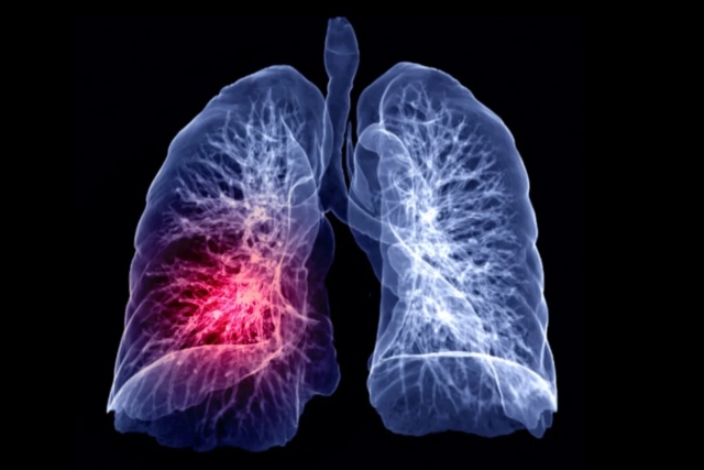 Beaucoup le considèrent comme normal… un symptôme précoce du cancer du poumon