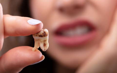 الصورة: الصورة: اكتشاف بكتيريا تسبب تسوس الأسنان في ضروس بشرية عمرها 4000 عام