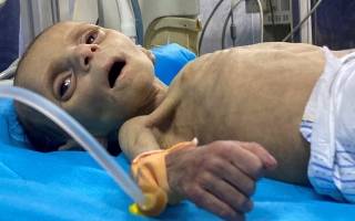 30 قتيلاً في غزة ضحية سوء التغذية والجفاف