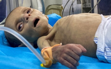 الصورة: الصورة: 30 قتيلاً في غزة ضحية سوء التغذية والجفاف