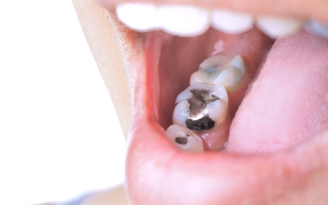 الصورة: الصورة: البرلمان الأوروبي يحظر حشوات الأسنان الزئبقية